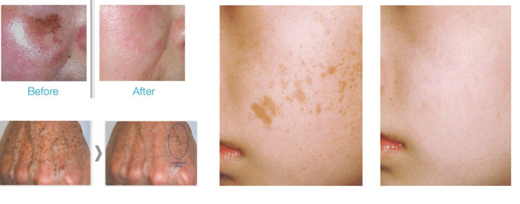 HYPERPIGMENTATION FINAL IMAGE