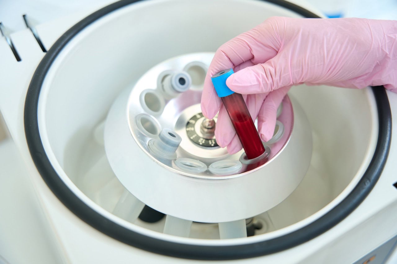 Platelet Rich Plasma (PRP)