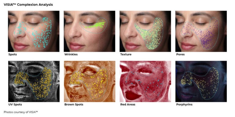 Skin Analysis with VISIA
